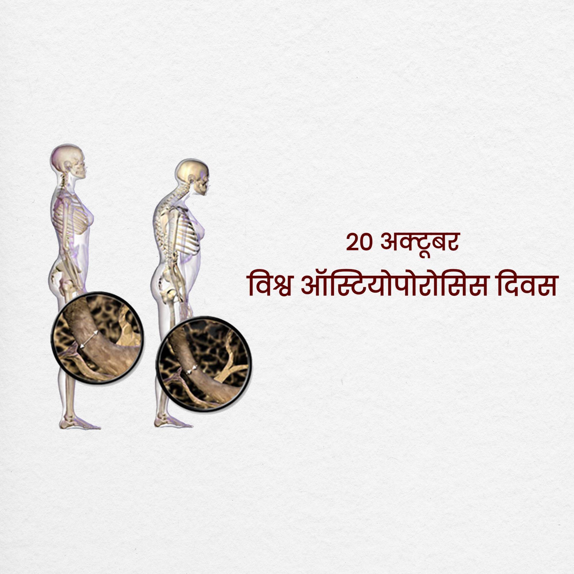 World Osteoporosis Day